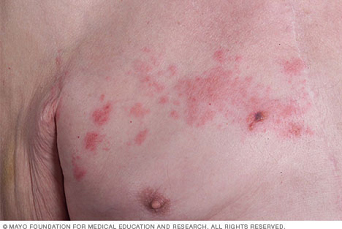 대상포진 증상 사진