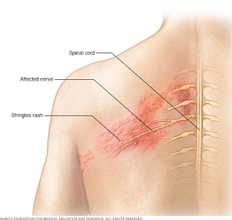 대상포진 원인 사진