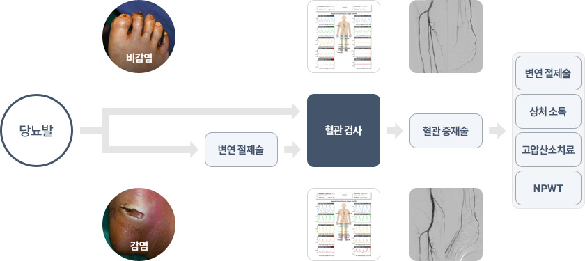 당뇨발 → 감염 → 변연 절제술 → 혈관 검사 → 혈관 중재술 → 변연 절제술, 상처소독, 고압산소치료, NPWT