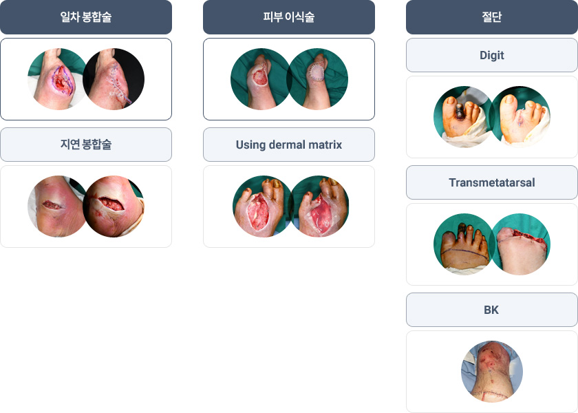 일차 봉합술 - 지연 봉합술, 피부이식술 - Using dermal matrix, 절단 - Digit, Transmetatarsal, BK