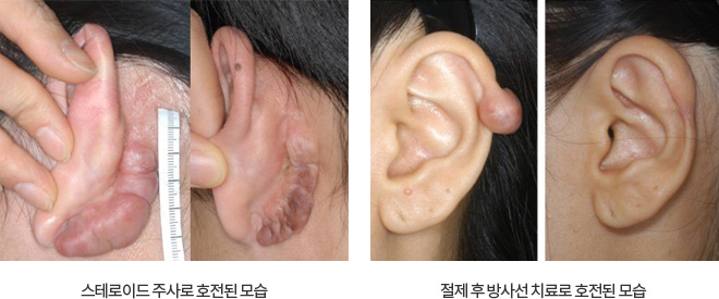 스테로이드 주사로 호전된 모습, 절제 후 방사선 치료로 호전된 모습