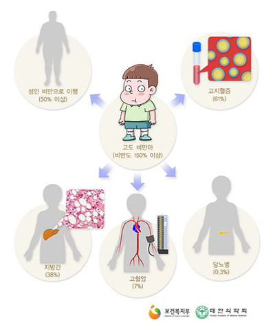 소아비만 이미지